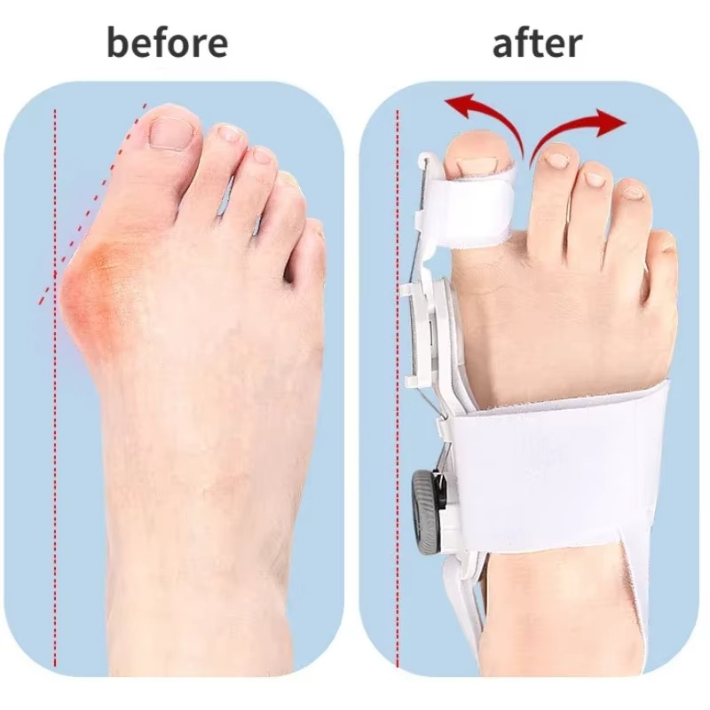 FLEXIBLE BUNION CORRECTOR